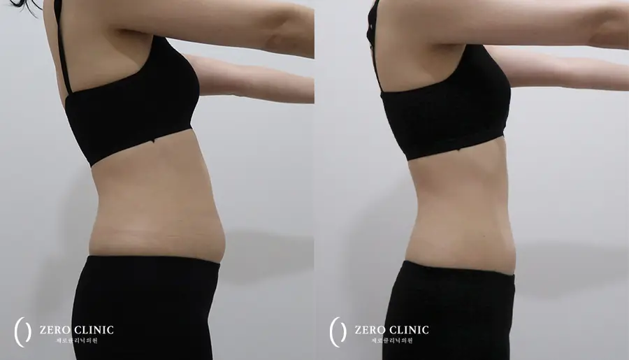 복부 지방분해주사 시술 전후 비교, 윗배·아랫배·옆구리 바디 제로컷 주 1회 5회, 제로클리닉 신사본점
